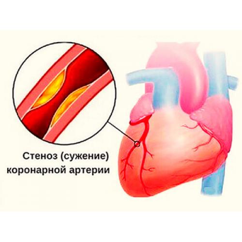 Как снять стенокардию в домашних условиях