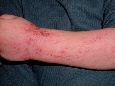 Аллергические и мокнущие дерматиты