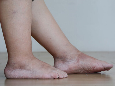 Хронические отеки ног