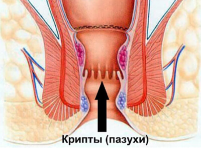 Хронический парапроктит