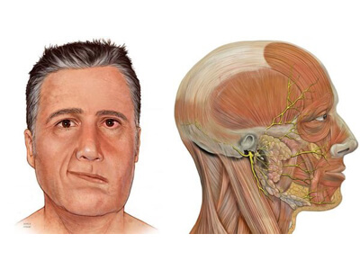 Периферический паралич лицевого нерва