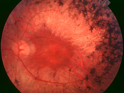 Пигментный ретинит