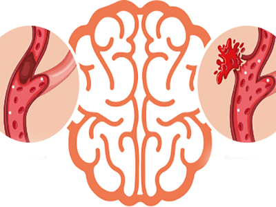 Заболевания кровеносных сосудов мозга